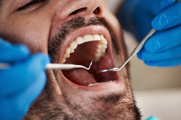 Best Emergency Wisdom Teeth Removal in Wamac, IL